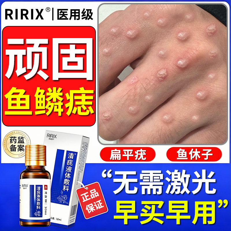鱼鳞痣非药膏皮赘肉粒手上长硬疙瘩肉刺疣瘊肉粒休子非去除液神器