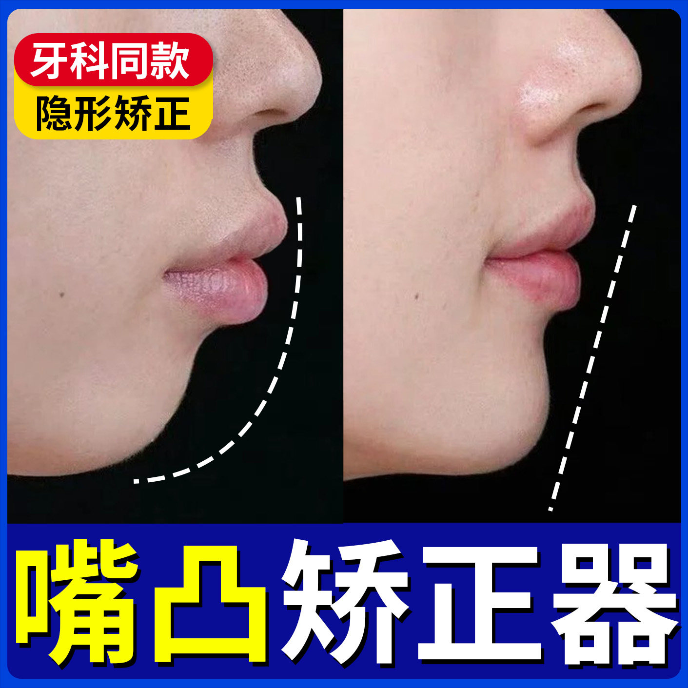 嘴凸下巴下颚后缩牙齿脸型矫正器成人儿童龅牙大小脸深覆合咬合板