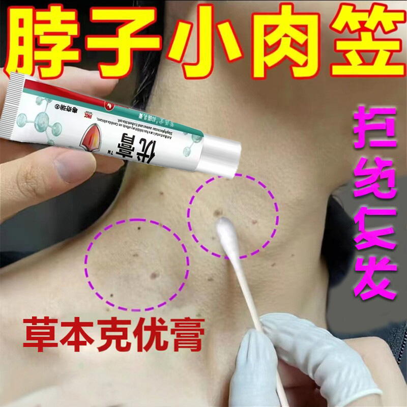 【无痛去优】草本优膏自然掉落