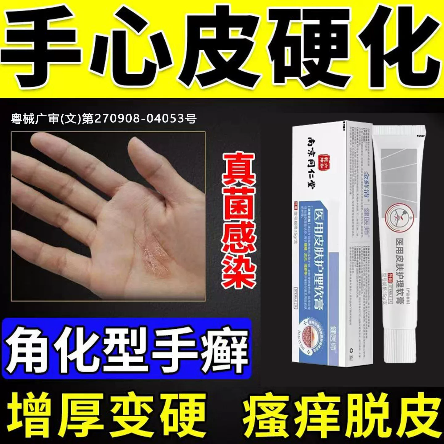 手心黄硬皮起皮角化型湿疹手藓真菌感染手癣膏药脱皮干裂鹅掌风TT