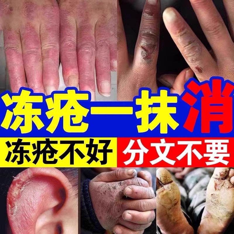 冻疮膏止痒冻伤膏防冻疮脚后跟干裂冻手足耳朵皲裂膏冬季滋润保湿