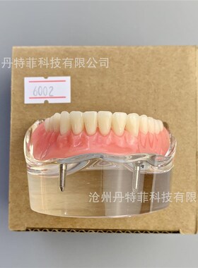 M6002牙齿修复模型 牙齿种植模型可拆卸种植牙展示模型