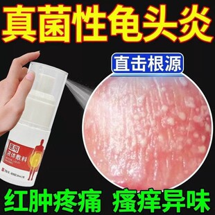 龟头炎珍珠丘疹包皮炎红点瘙痒豆腐渣白垢男性冠状沟真菌感染喷剂