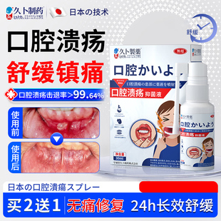 久卜口腔溃疡灵黏膜修复液口疮舌头上火起泡喷雾漱口水