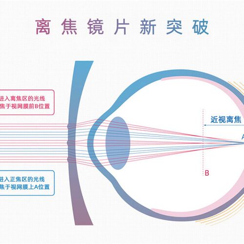 青少年近视多点离焦镜片微透离焦防止度数长乐点控多焦点镜儿童