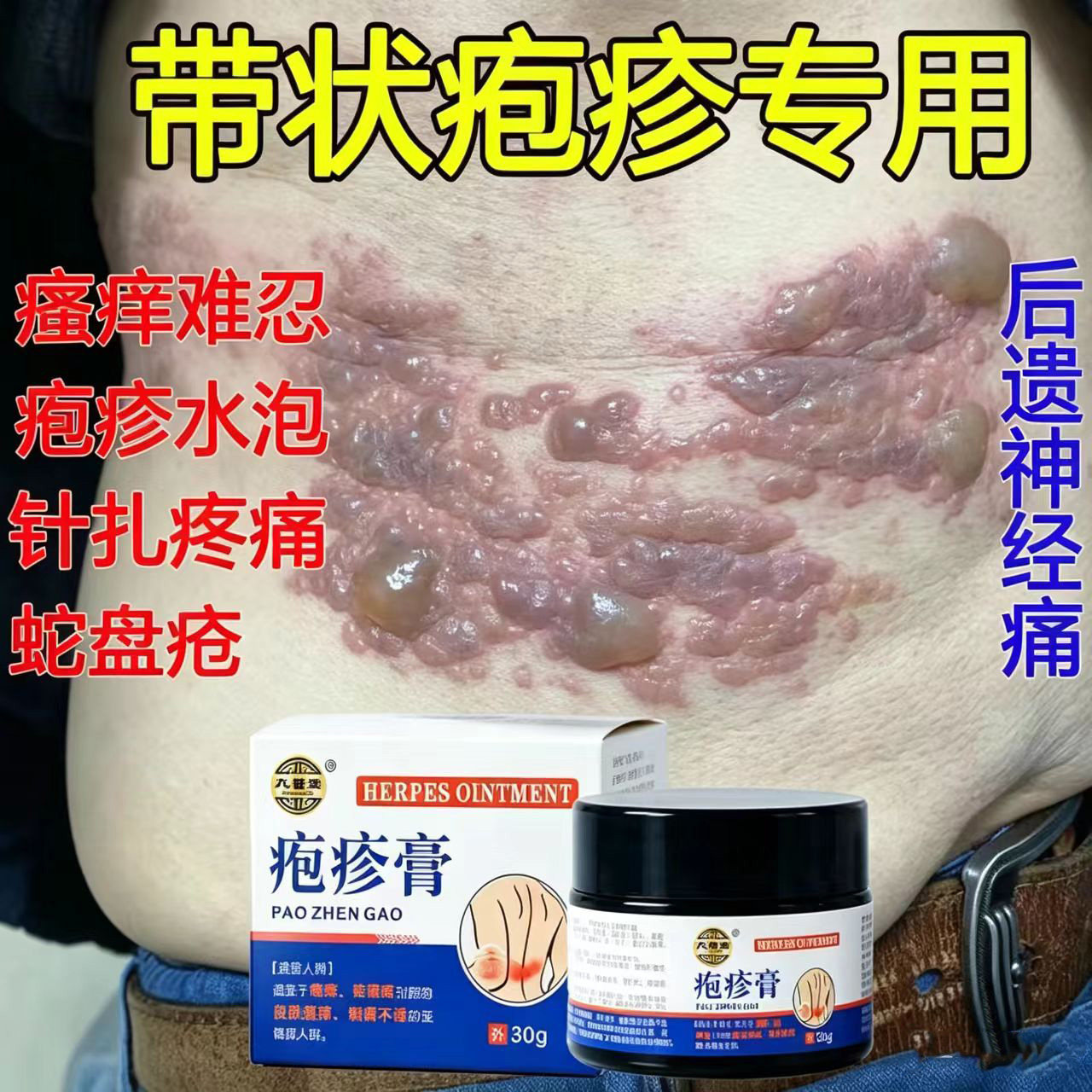 带状疱疹消痛止痒水泡蛇盘疮修复