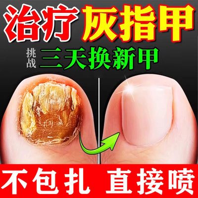 【伊人】盐酸特比萘芬喷雾剂1%*15ml*1瓶/盒