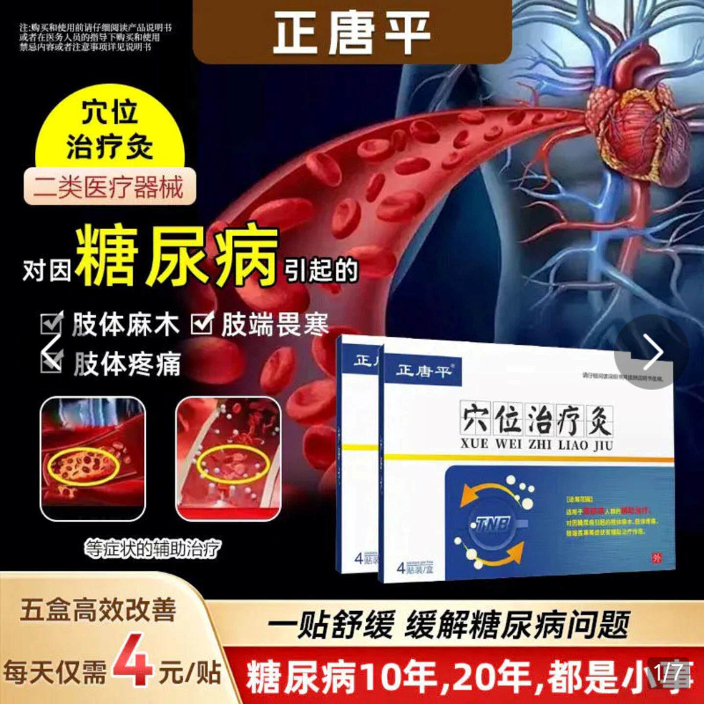 正唐平穴位治疗灸糖尿病