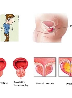 Prostatic Navel Plaster Prostatitis Urology 邦德丽前列脐贴