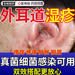 外耳道湿疹耳朵干燥起皮真菌感染耳朵发炎流脓药膏可搭滴耳液SJ