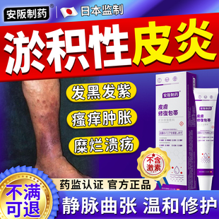 淤积性皮炎专小腿硬化静脉炎用老烂腿药静脉曲张膏湿疹止痒凝胶KY