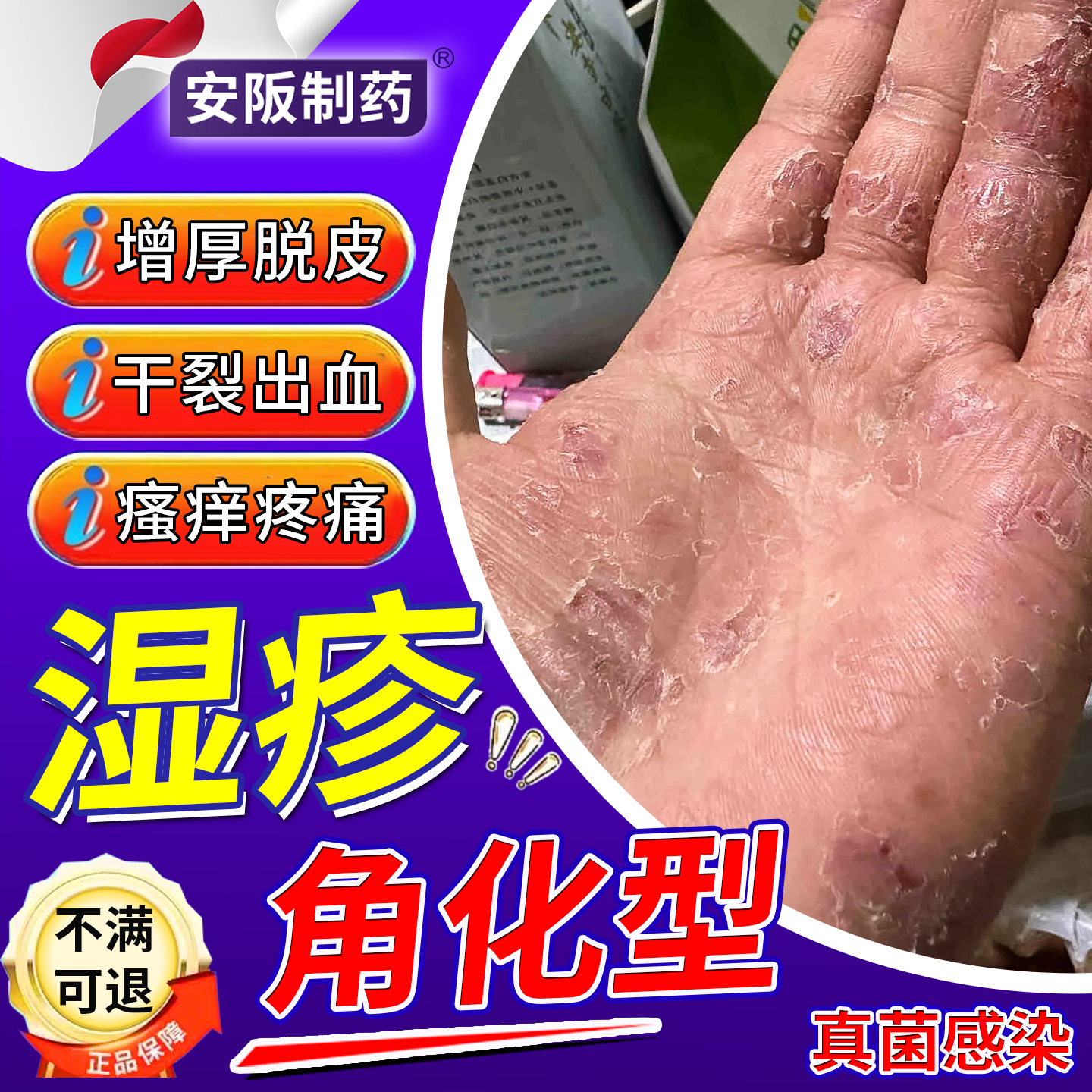 角化型湿疹手癣膏脱皮干裂真菌感染手指皲裂粗糙增厚药膏止痒KY