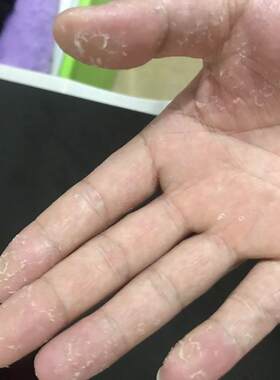 24手脱皮修复霜手掌手指蜕皮严重专用儿童护手蜕皮手足起皮掉皮膏
