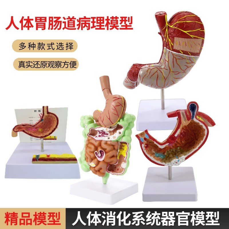 病理肠胃模型g人体胃与穿孔病态胃模型消化科胃冠状剖面解剖内脏