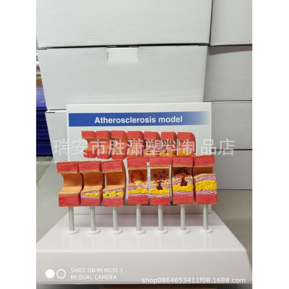 动脉病变硬化模型 血管血栓栓塞模型动脉血管脂血管堵塞病态血管