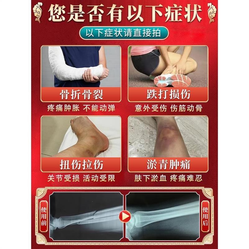骨折骨裂恢复药快速接骨续筋膏活血化瘀跌打损伤促进骨折愈合膏药