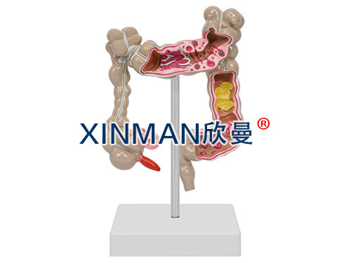 大肠病变模型