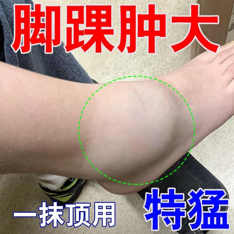 脚踝肿大疼痛膏药膏骨裂关节肿大陈旧老伤活血化瘀韧带拉伤专用膏