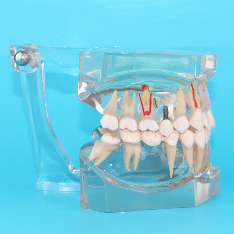 医信MDCD生产2.5倍牙病理模型单色 牙龈炎 牙周炎代发口腔牙齿,文具电教/文化用品/商务用品,教学标本/模型,淘宝优惠券,粉丝福利购,淘宝优惠卷