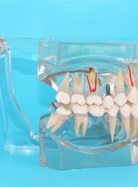 医信MDCD生产2.5倍牙病理模型单色 牙龈炎 牙周炎代发口腔牙齿