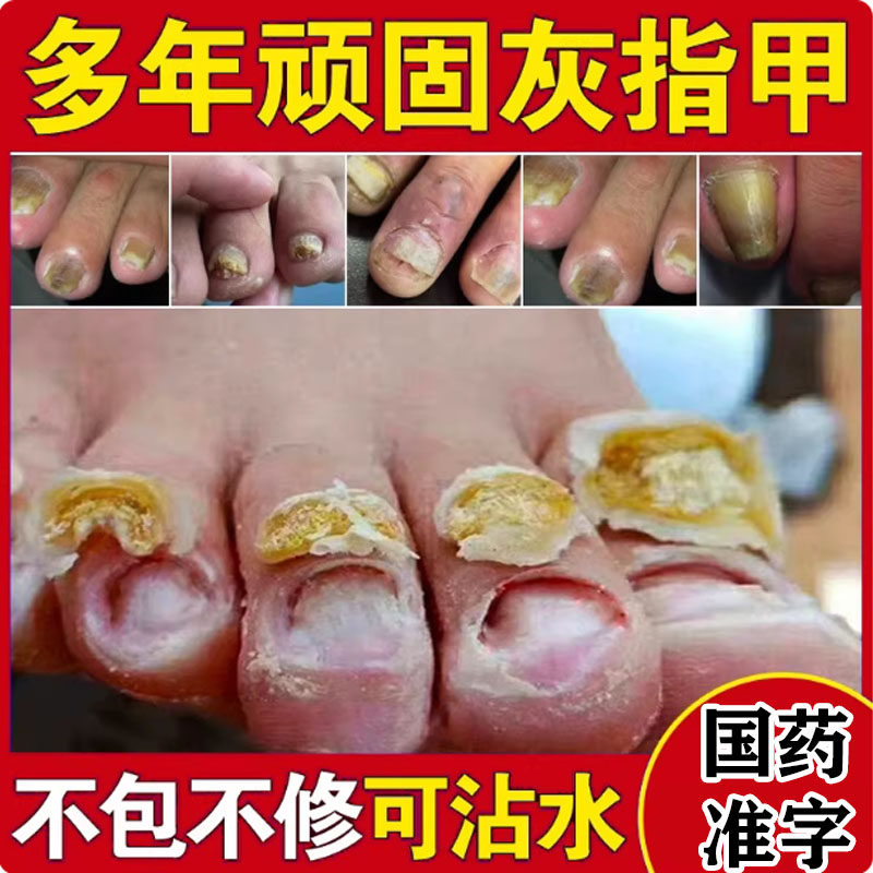 去灰指甲用药水膏脱甲除真菌感染手脚甲沟炎根特效第一名亮甲YY