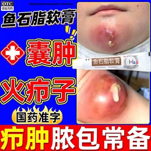 鱼石脂软膏正品官方旗舰店疖肿消炎乳膏国药准字火疖子毛囊炎药膏