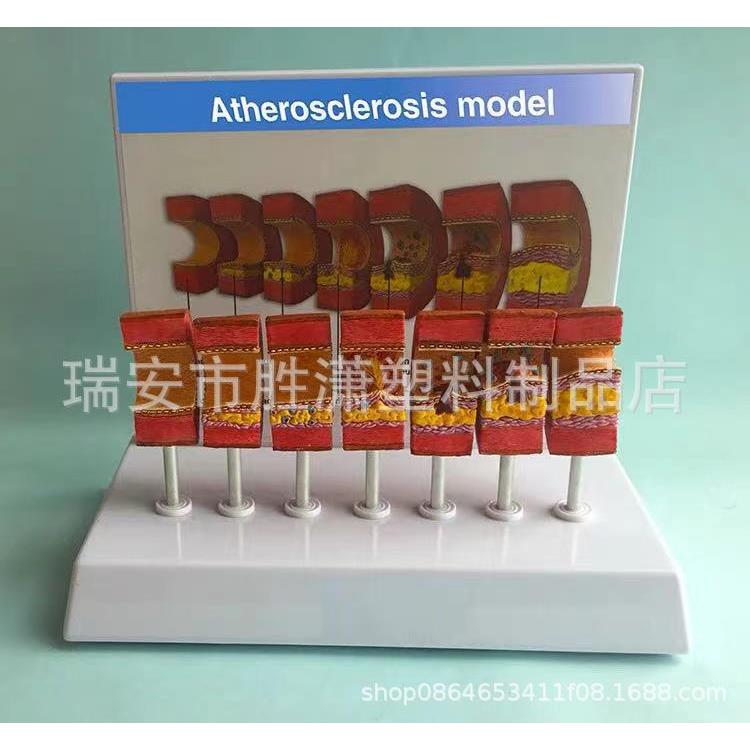 动脉病变硬化模型 血管血栓栓塞模型动脉血管脂血管堵塞病态血管