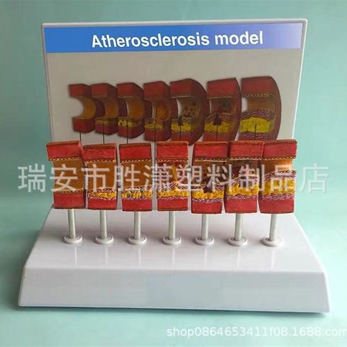 动脉病变硬化模型 血管血栓栓塞模型动脉血管脂血管堵塞病态血管