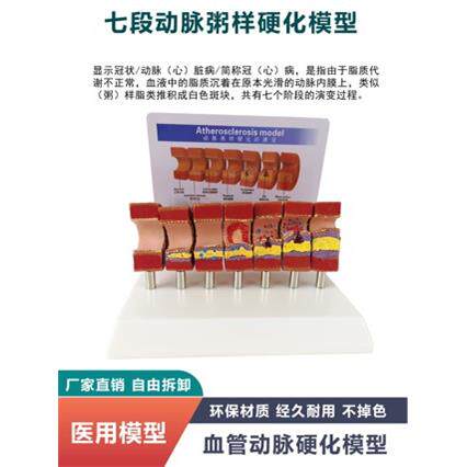 人体血管模型内膜病理阻塞狭窄脂肪堆积中老年人心脏冠状动脉栓子