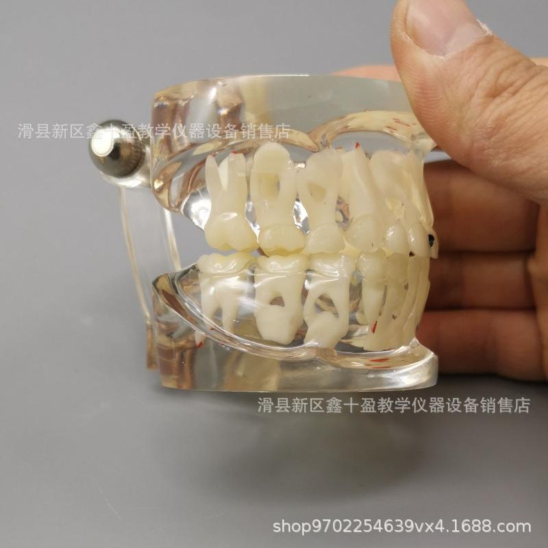儿童病理模型 乳恒牙交替带龋坏蛀牙齿水晶透明牙齿模具 乳牙列