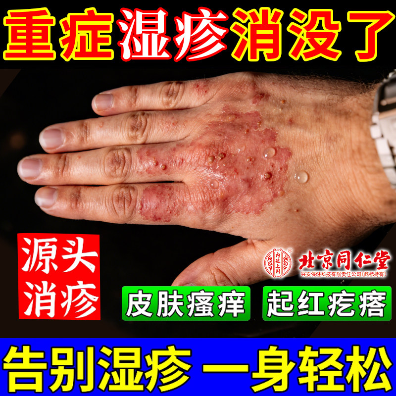 重楼解毒酊湿疹药膏止痒去外用根顽固皮炎皮肤瘙痒欧姆康小白瓶