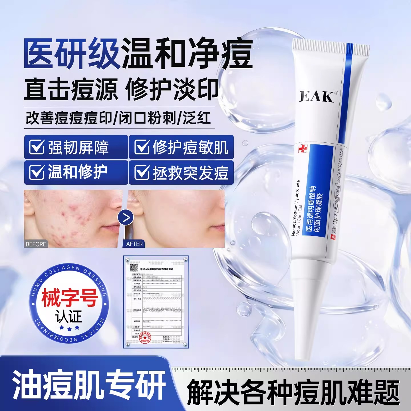 EAK透明质酸钠凝胶祛痘精华膏淡痘印坑去闭口粉刺黑头青春痘控油