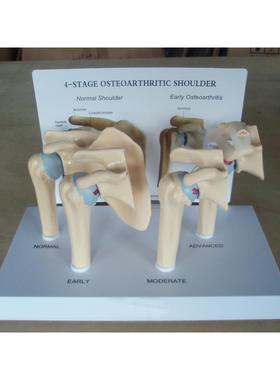 SMM035四阶段病理肩关节