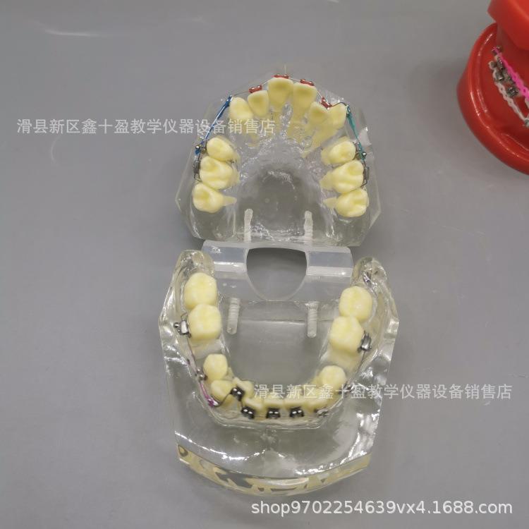 齿正畸模型缺失牙牙齐错颌牙列不矫正金属托槽带支抗牵92870引皮