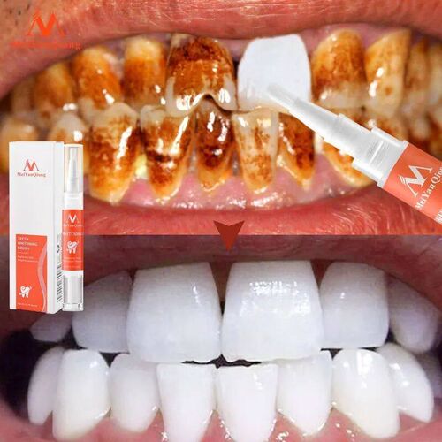 MeiYanQiong Teeth Whitening Pen Remove Plaque And Tartar Cle