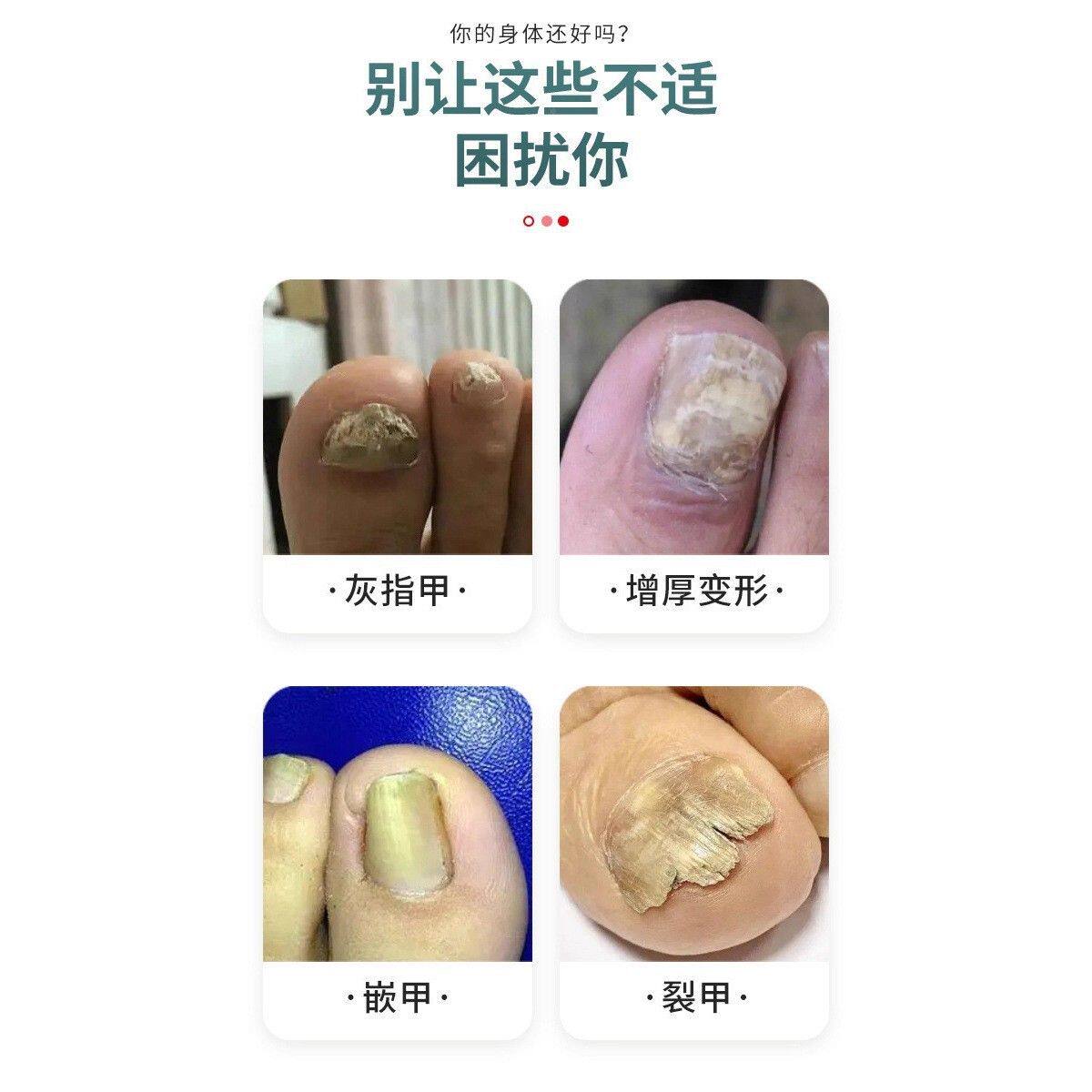 用东制药灰岐甲贴缓HJR灰指甲脆甲烂甲发黄护解甲亮甲养甲外灰甲