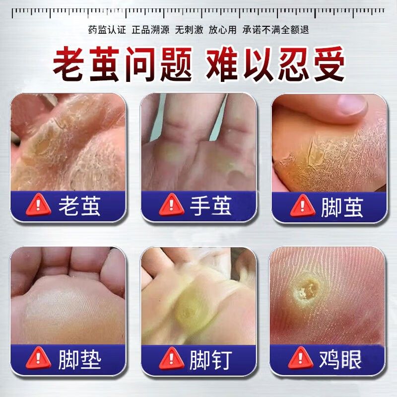 云南本草茧清灵眼软化去MKL脚趾方底鸡板掌手足部厚死皮抑菌液官