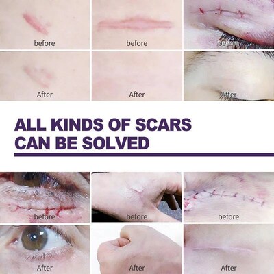 8pcs Silicone Scar Sheets Painless Repair Tape Scar Removal