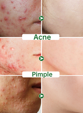 Acne Face Cream Herbal Pimple Scar Removal Shrink Pore Oil C