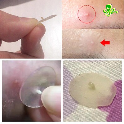 Acne Pimple Patch  Stickers Acne Treatment Pimple Remover To