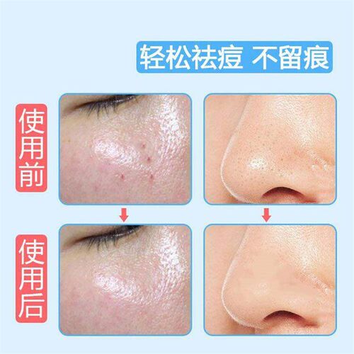 Stainless Steel Acne Needle, Pimple Extractor, Blackhead Rem