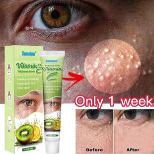 Fat Granules Remover Eye Cream Effective Remove Fat Granules