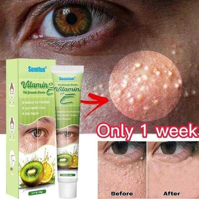 Fat Granules Remover Eye Cream Effective Remove Fat Granules