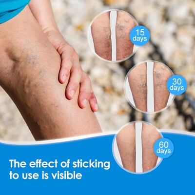 8pcs Varicose Veins Patch Phlebitis Vasculitis Treat Sticker