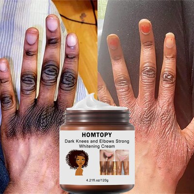Dark Knees and Elbows Strong Whitening Cream