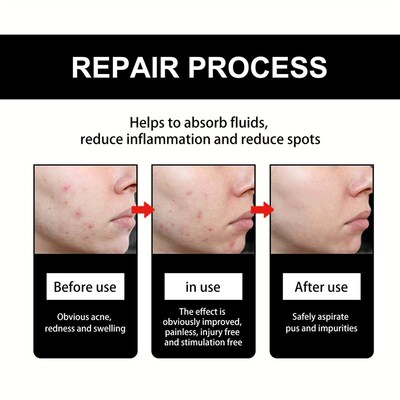 Hoygi Cute Black Acne Patch - Reduces spots, blackheads, and