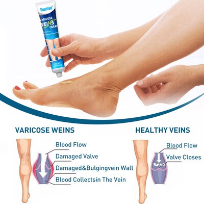 Varicose Veins relieves Cream Leg Vasculitis Phlebitis Spide