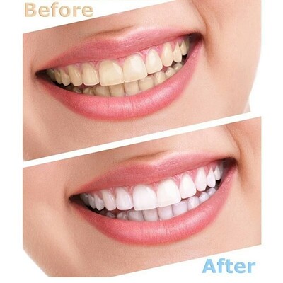 Teeth Whitening Gel Kit Oral Health Dental Bleaching Care