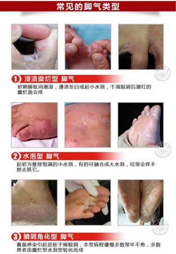 Foot Cream Feet Care For Athletes Foot,Blisters,Peeling Fe