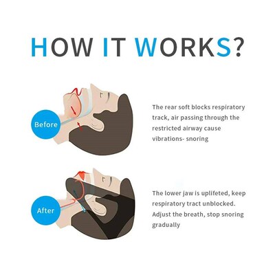 Anti Snore Stop Snoring Chin Strap Antisnoring Sleep Device